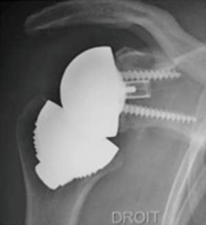reverse total shoulder orthobullets|Stemless reverse total shoulder arthroplasty: a  .